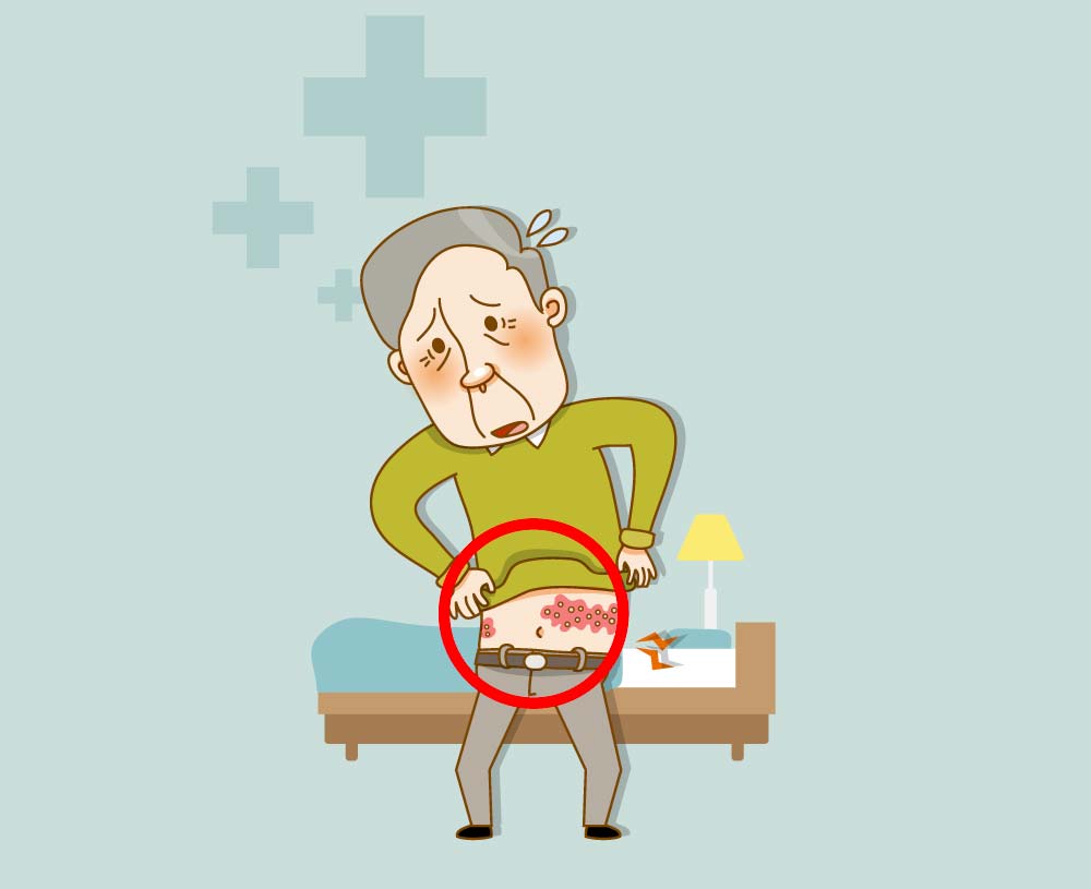 대상포진은 이렇게 생긴다