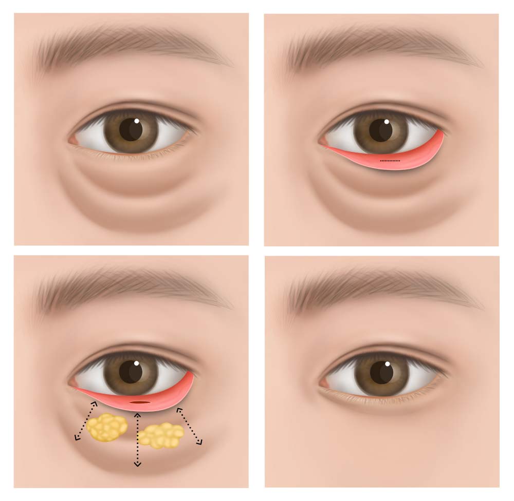 눈밑지방재배치, 수술방법은?